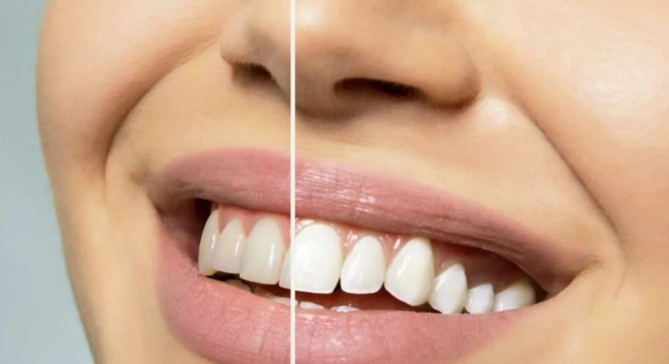Отбеливание зубов: секреты идеальной улыбки без компромиссов