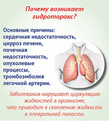 Жидкость в легких: в чем опасность для пожилых? Жидкость в легких: в чем опасность для пожилых?