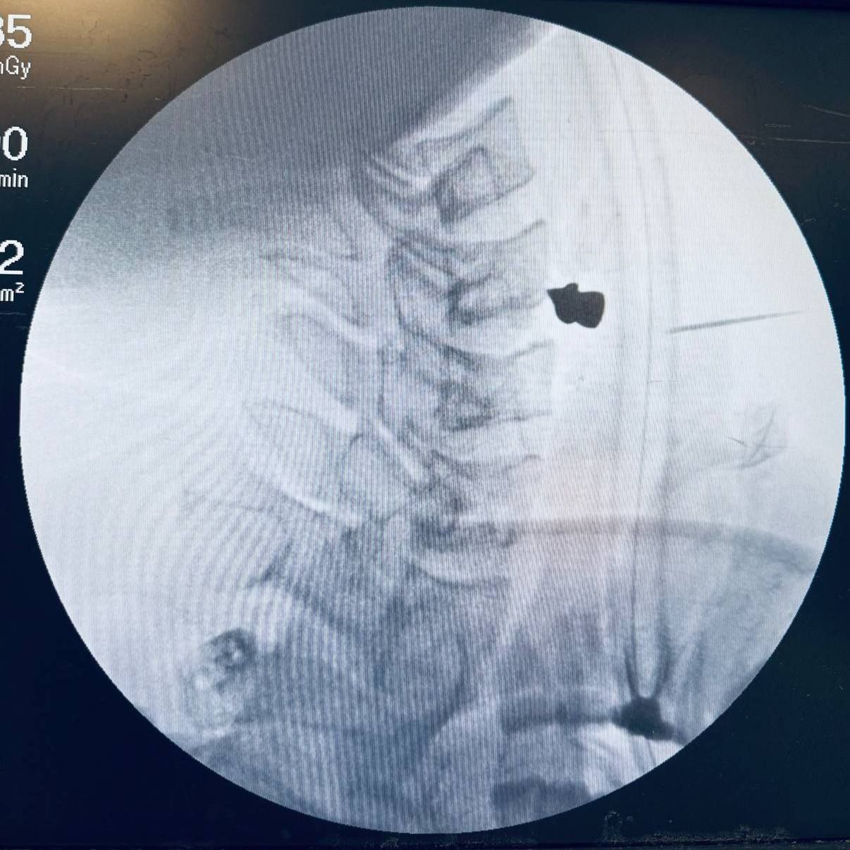 Парень случайно выстрелил себе в шею из пневмата Парень случайно выстрелил себе в шею из пневмата