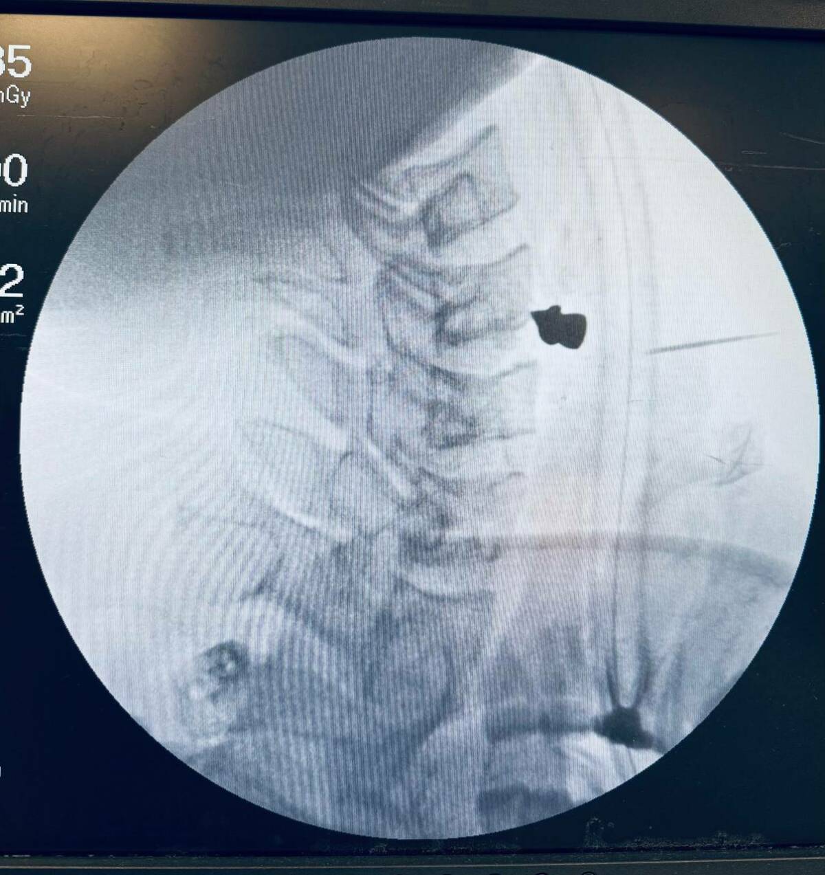 Врачи РКБ в Казани спасли 25-летнего пациента, извлекши пулю из его шеи, сообщает пресс-служба клиники