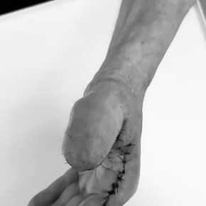 Микрохирурги вырастили челнинцу новый палец