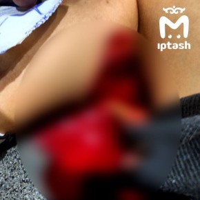 Девятилетняя девочка разорвала голень в казанском спортклубе