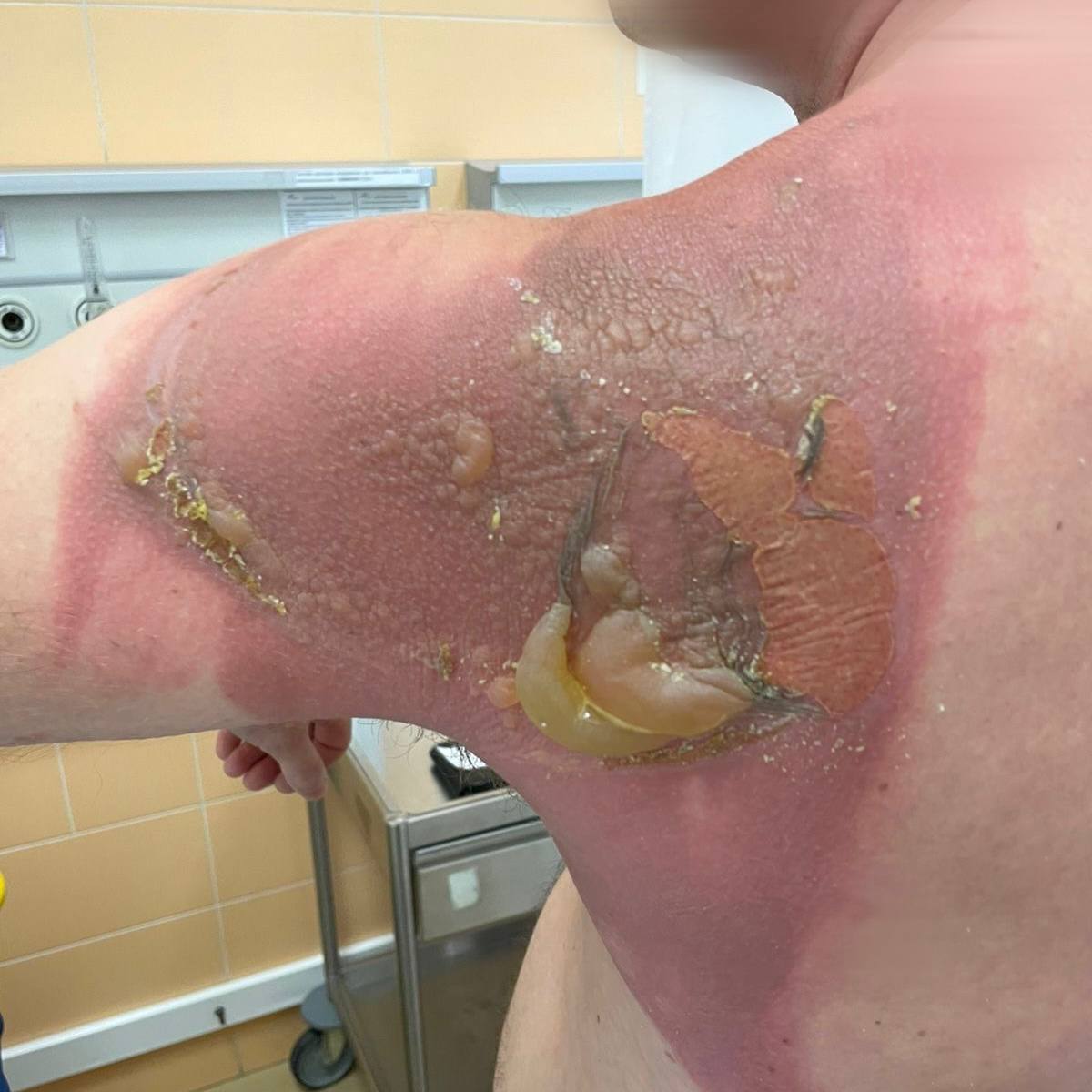 Химический ожог второй степени получил казанец из-за китайских капсул для стирки