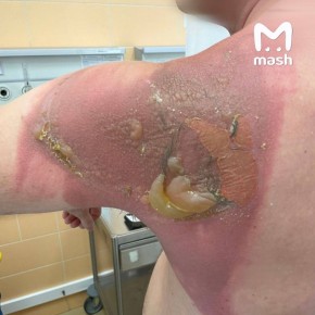 Парень из Татарстана сжёг спину, поспав на свежепостиранном новыми азиатскими капсулами постельном белье