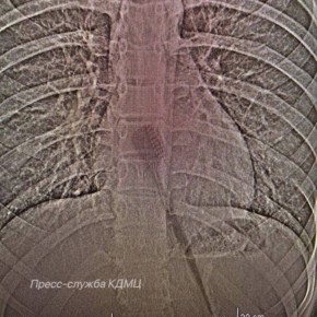 Подросток случайно проглотил зубную щётку