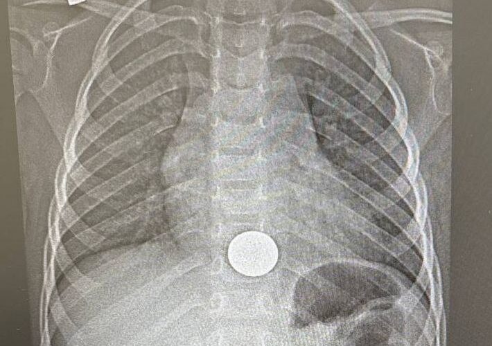 В Татарстане врачи спасли трехлетнего малыша, который случайно проглотил монету