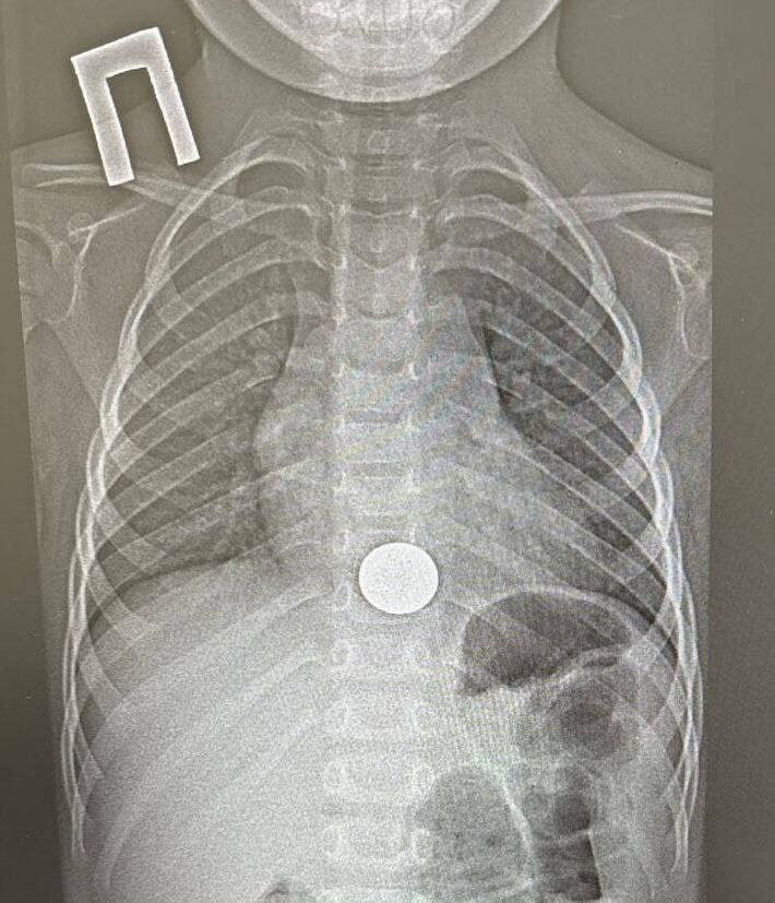 В Нижнекамске врачи детской районной больницы извлекли монету из пищевода ребенка