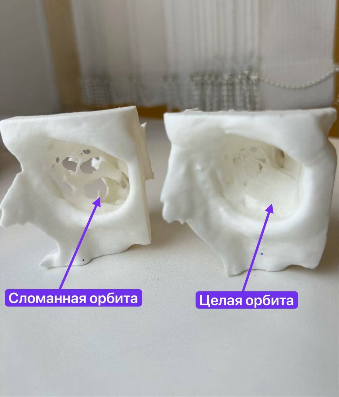 В Республиканской клинической больнице Татарстана мужчине восстановили орбиту глаза после тяжёлой травмы с применением реберного хряща В Республиканской клинической больнице Татарстана мужчине восстановили орбиту глаза после тяжёлой травмы с применением реберного хряща