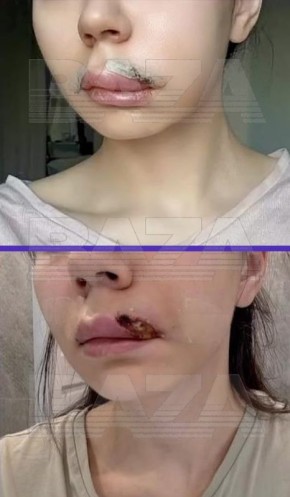 Жительница Казани хотела увеличить губы с помощью филлеров, но оказалась на операционном столе из-за воспаления тканей после процедур