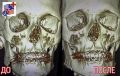 В Нижнекамске врачи за 40 минут восстановили челюсть мужчине после падения с самоката