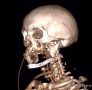 Онкологи Татарстана воссоздали челюсть пациентки после удаления большой опухоли с помощью протеза, напечатанного на 3D-принтере